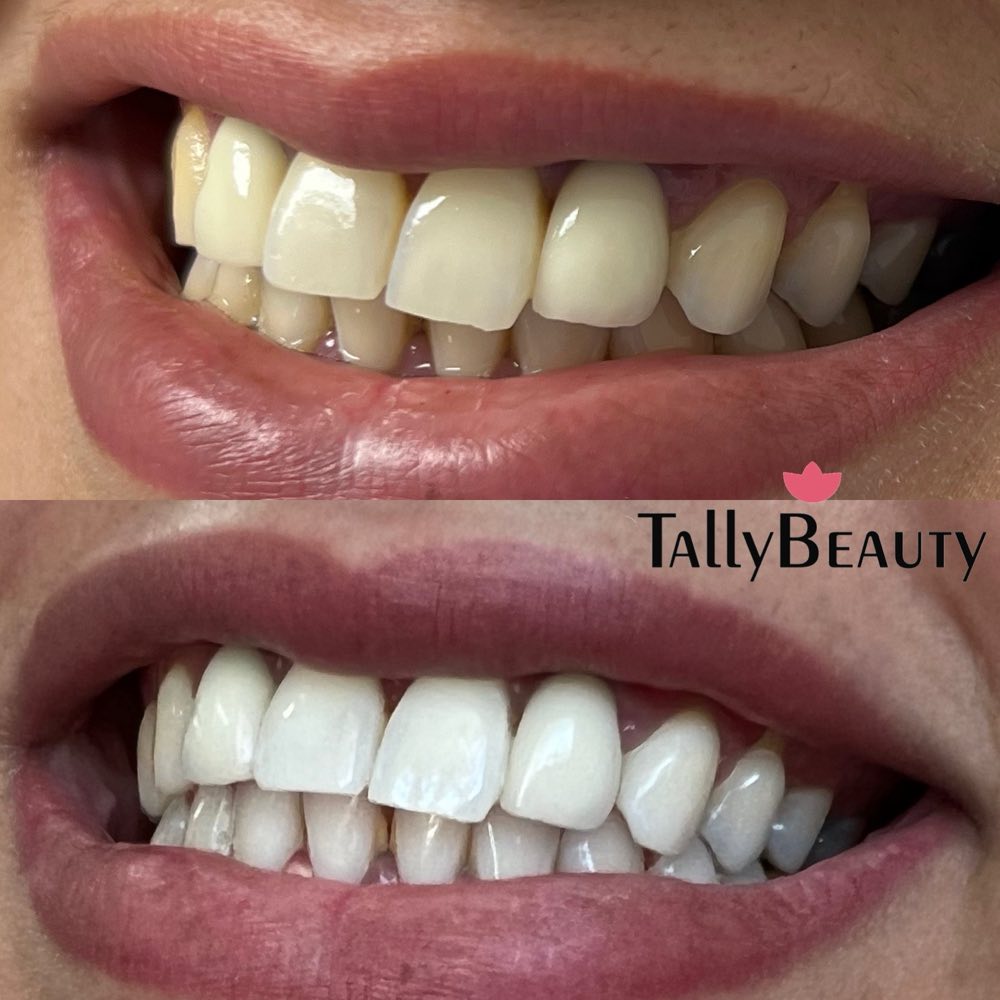 Teeth whitening before and after